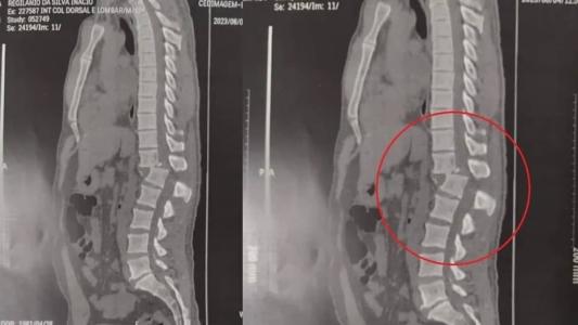 Raio-X mostra lesão na coluna do homem atingido por aparelho de academia