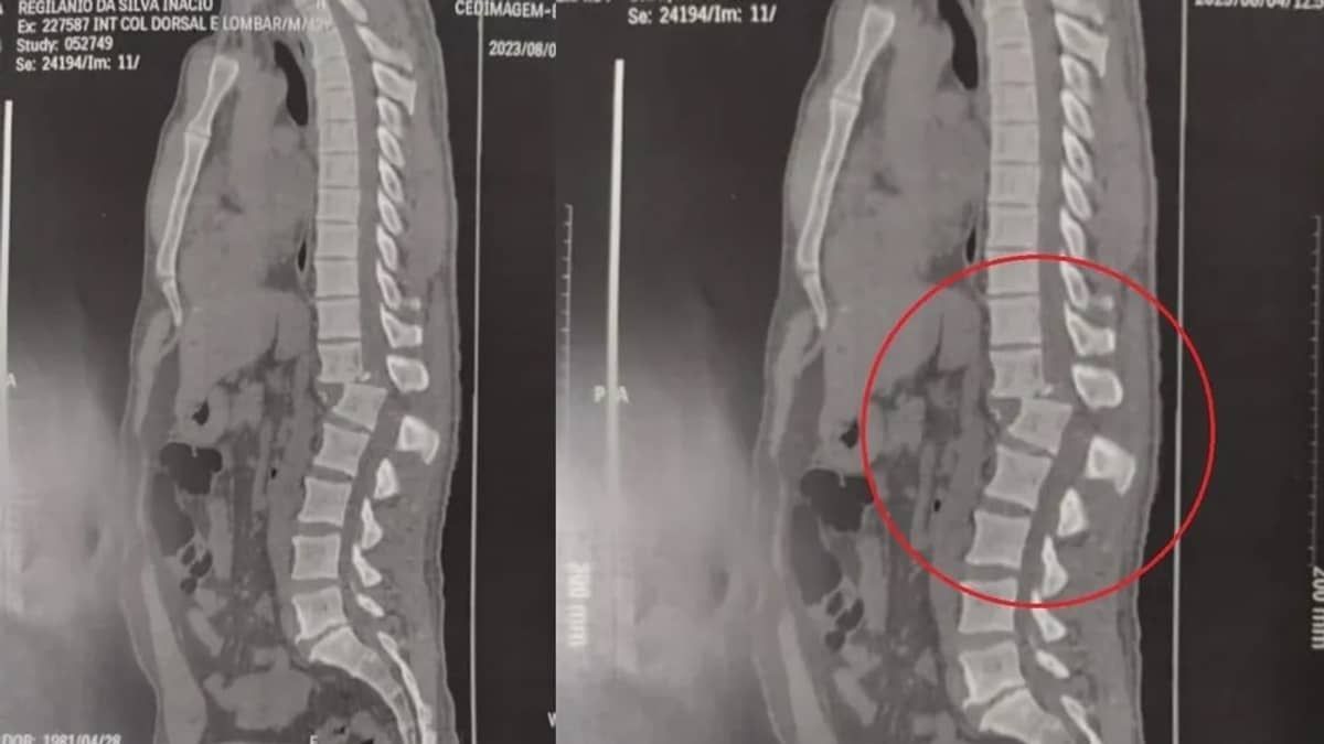 Raio-X mostra lesão na coluna do homem atingido por aparelho de academia; veja