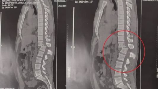 Regilânio tem menos de 1% de chance de voltar a andar