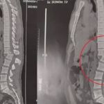 Raio-X mostra lesão na coluna do homem atingido por aparelho de academia; veja