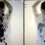 Anvisa autoriza pesquisa clínica sobre tratamento revolucionário contra o câncer