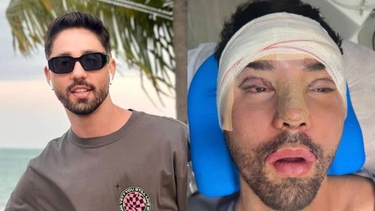 Rico Melquíades realizou diversos procedimentos estéticos após ataques de haters