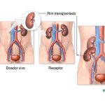 Três rins? Dois pâncreas? Médico explica dinâmica de transplantes de órgãos