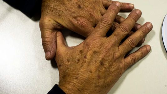 O câncer de pele é o tipo de câncer mais comum do Brasil e representa 30% de todos os tumores malignos registrados no país