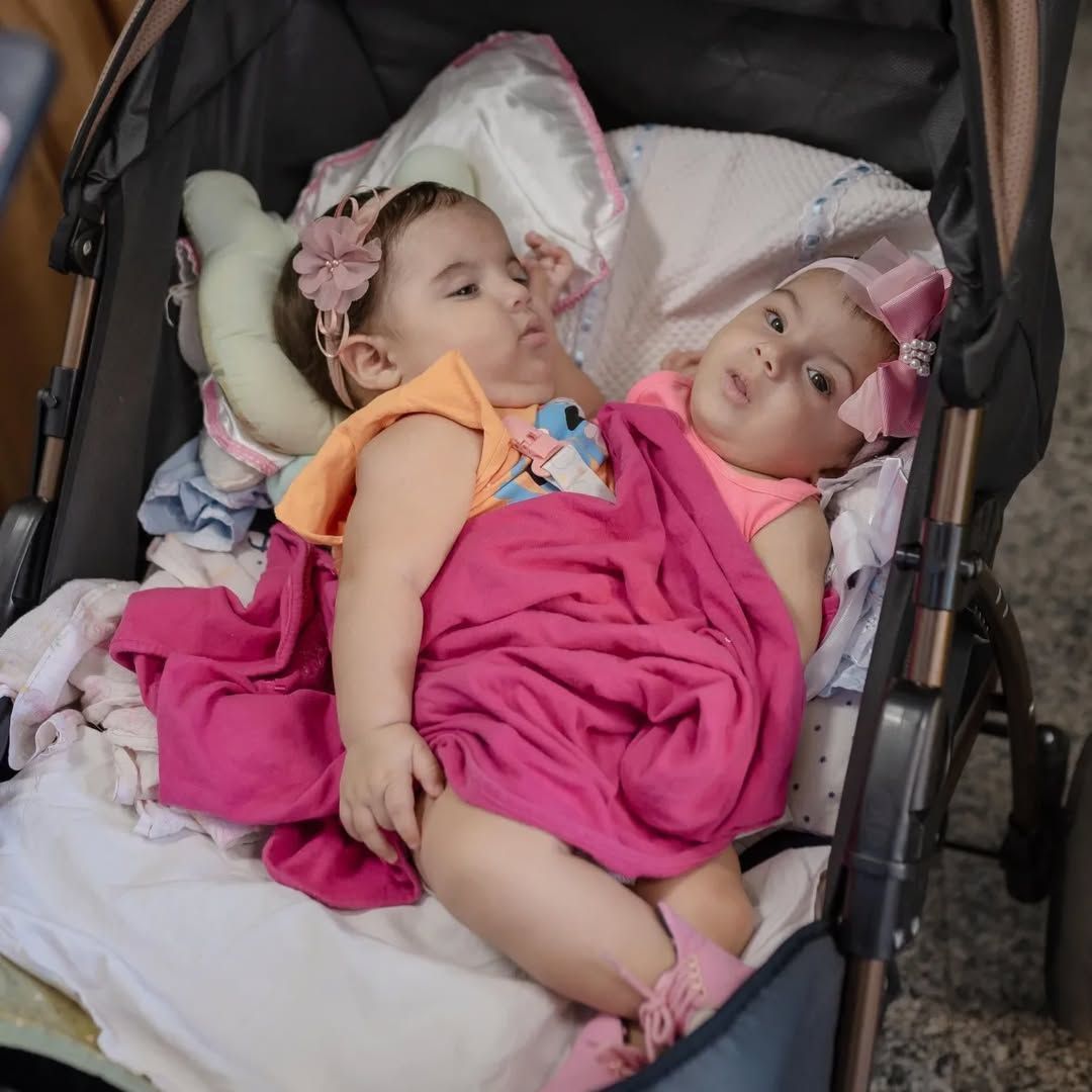 Gêmeas siamesas unidas por órgãos farão cirurgia de separação neste sábado (10), em Goiás