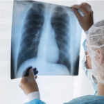 Casos de pneumonia registram crescimento em Ouro Preto