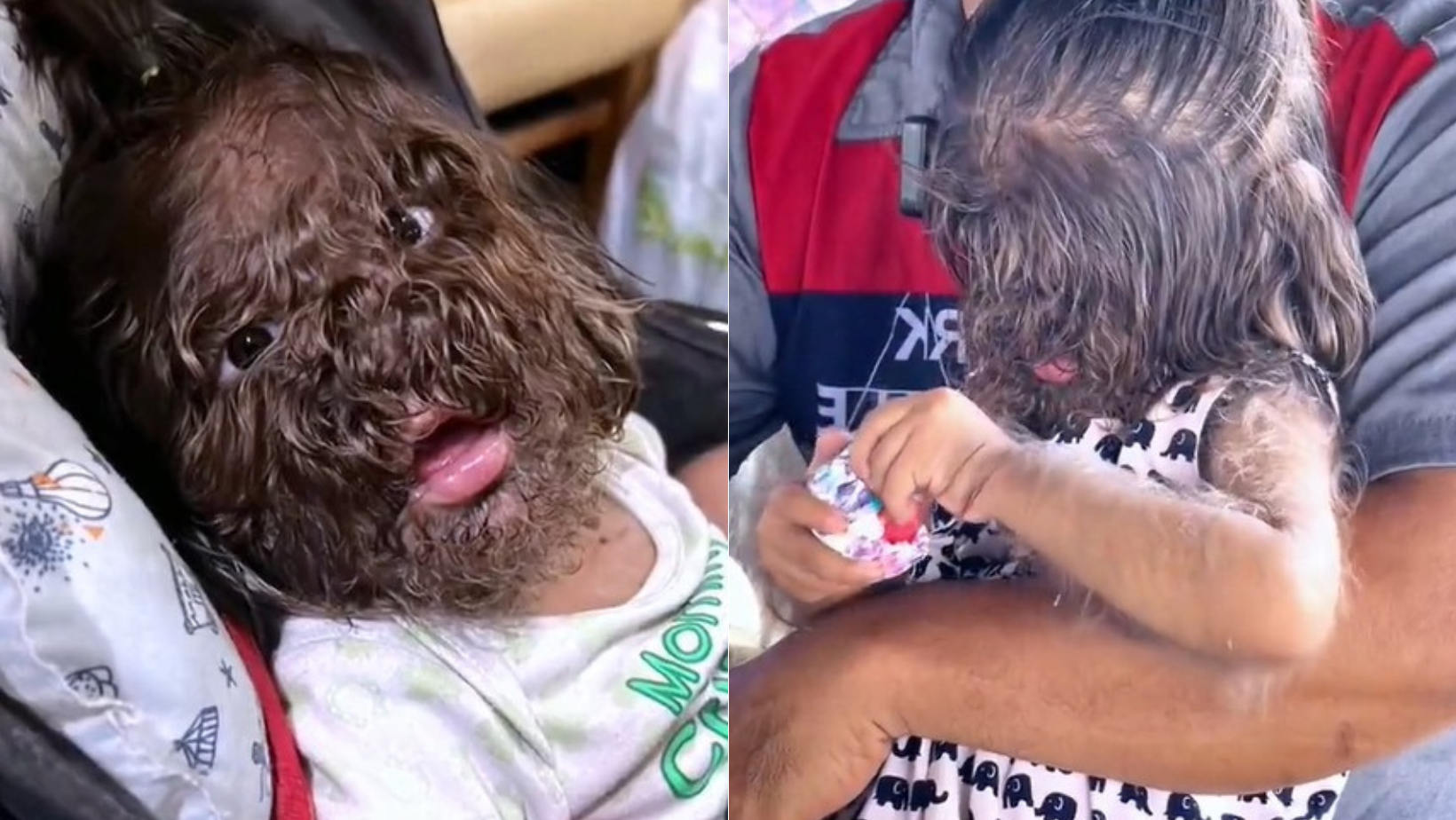 Vídeo de menina com 'Síndrome de Lobisomem' viraliza: saiba o que é, sintomas e se tem cura