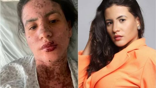 Síndrome de Stevens-Johnson: conheça a doença que afetou mulher de Frank Aguiar.