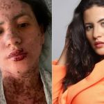 Síndrome de Stevens-Johnson: conheça a doença que afetou mulher de Frank Aguiar