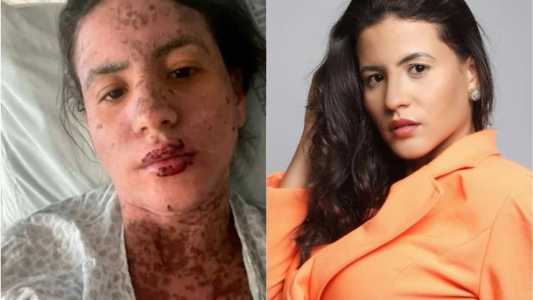 Síndrome de Stevens-Johnson: conheça a doença que afetou mulher de Frank Aguiar.