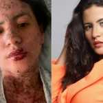Síndrome de Stevens-Johnson: conheça a doença que afetou mulher de Frank Aguiar