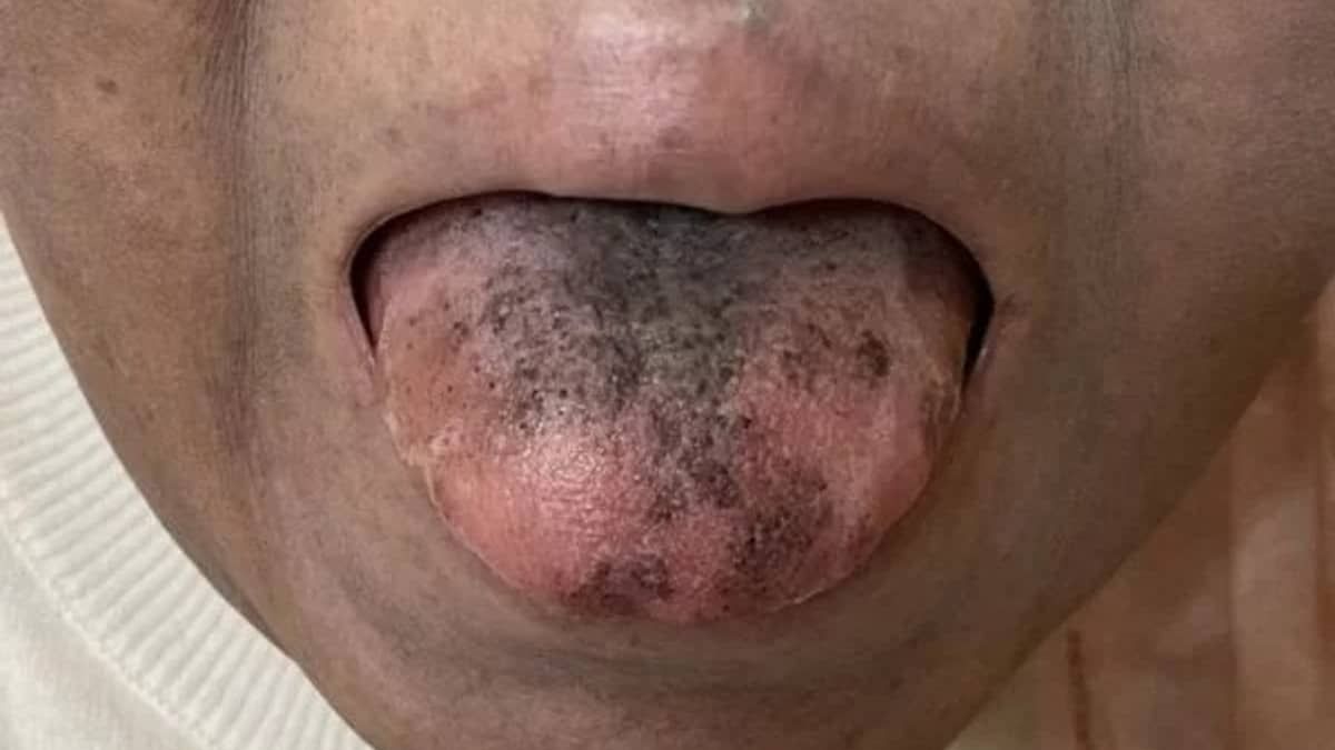 Mulher fica com língua preta e peluda durante tratamento de câncer; entenda
