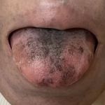 Mulher fica com língua preta e peluda durante tratamento de câncer; entenda