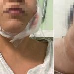 Surto de micobactéria pode ter causado infecções após 'lipo de papada' em BH