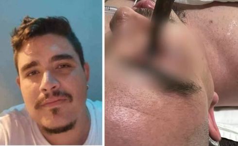 Foto mostra Osmar Júnior, homem de 31 anos que teve o olho perfurado pr um taco de sinuca