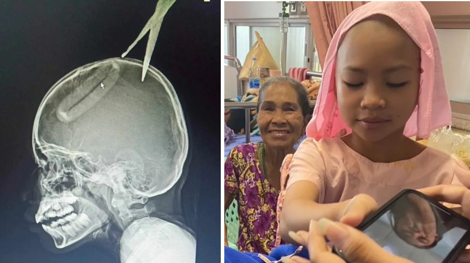 Menino de 4 anos enfia tesoura no crânio da irmã após ver cena de luta na TV