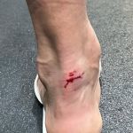 Fluminense reclama de falta em Cano; veja imagem do tornozelo do jogador