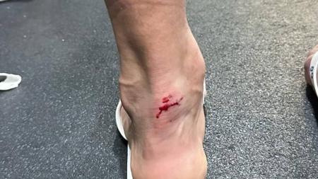 Tornozelo de Cano após a partida contra o Vasco, em pisão de Paulinho