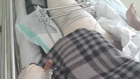 Trabalhador teve fraturas expostas na perna e punho