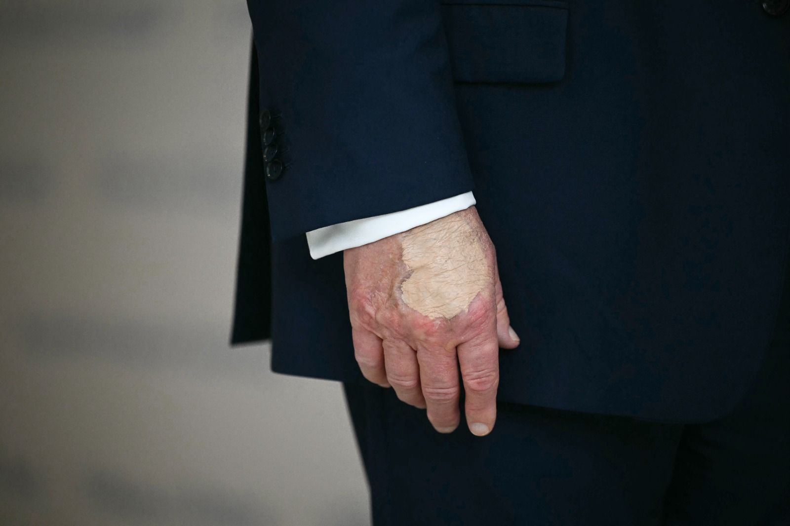 Trump aparece com hematomas cobertos por maquiagem um mês após diagnóstico de saúde