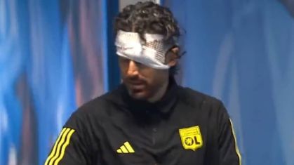 Um curativo foi feito acima da sobrancelha esquerda de Fabio Grosso, treinador do Olympique Lionnais