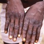 Mpox: OMS já confirmou 258 casos de nova variante fora do Congo