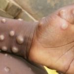 Cidade do Rio teve mais de 1.200 casos de mpox desde 2022