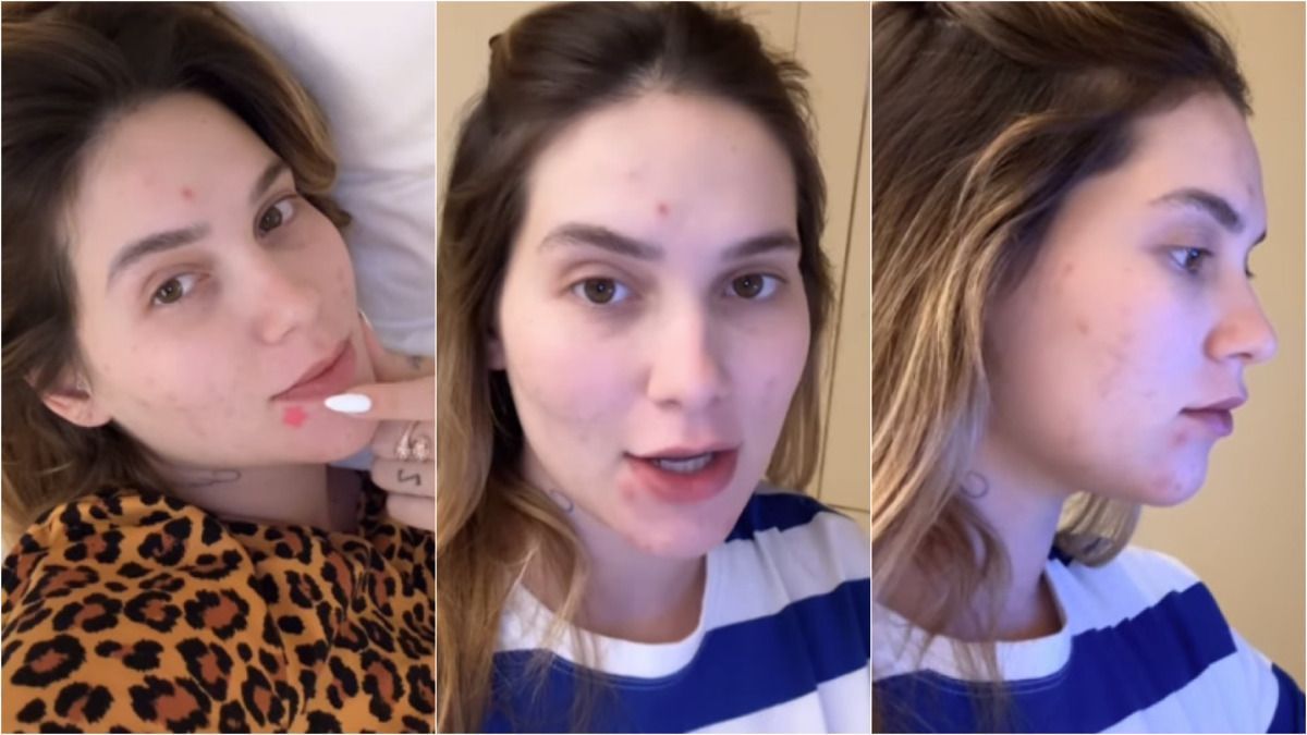 Grávida de 8 meses, Virginia enfrenta acne gestacional; entenda causas e tratamentos