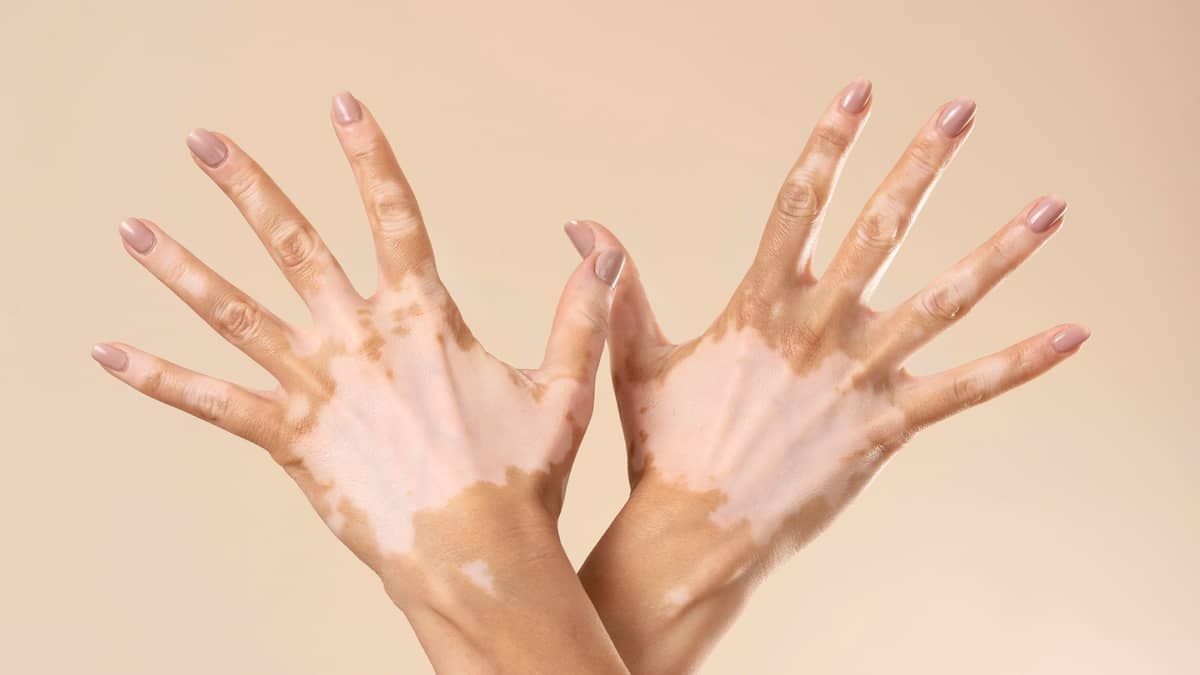 Vitiligo não é transmitido entre pessoas; mitos sobre doença reforçam discriminação