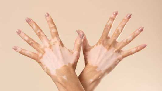 O Dia Mundial do Vitiligo, celebrado neste domingo (25)