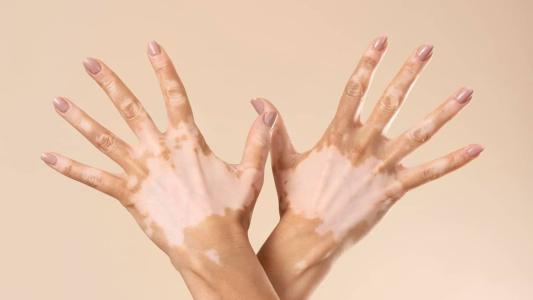 O Dia Mundial do Vitiligo, celebrado neste domingo (25)