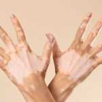 Vitiligo não é transmitido entre pessoas; mitos sobre doença reforçam discriminação