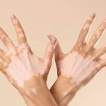 Vitiligo não é transmitido entre pessoas; mitos sobre doença reforçam discriminação