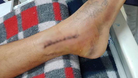 Vítima fraturou o tornozelo e rompeu os ligamentos