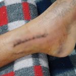 Vítima de acidente de trânsito denuncia descaso em unidades de saúde de BH