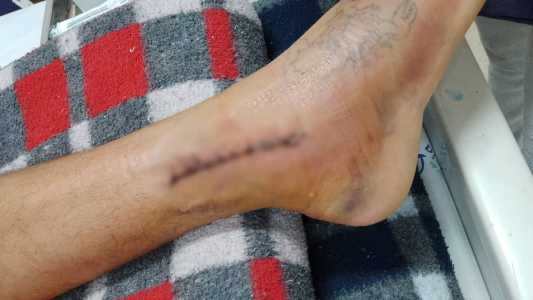 Vítima fraturou o tornozelo e rompeu os ligamentos