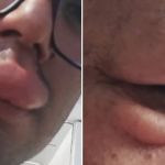 Marimbondos atacam moradores que ficam com rostos deformados em Santa Luzia  