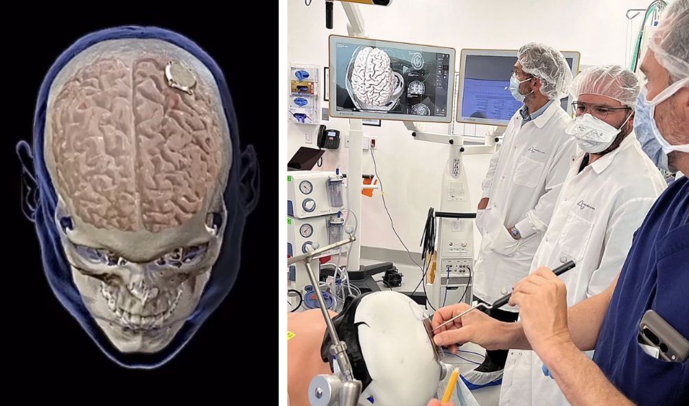 O que é o implante da Neuralink, de Musk? Chip pode fazer pagamentos e controlar celular