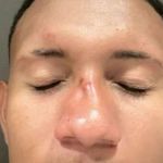 Jogador do Caxias sofre fatura no nariz após pancadaria no Beira-Rio