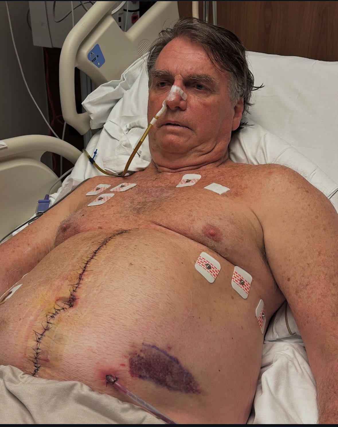 Bolsonaro posta foto e mostra cicatriz na barriga após cirurgia de reconstrução abdominal