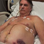 Bolsonaro posta foto e mostra cicatriz na barriga após cirurgia de reconstrução abdominal