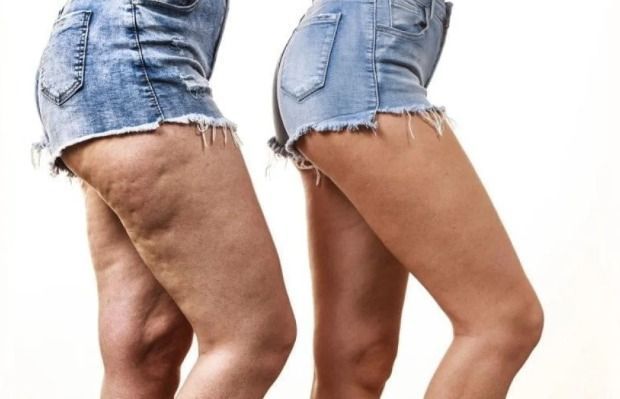 Médica explica diferença entre varizes e lipedema, doenças que afetam milhões no Brasil