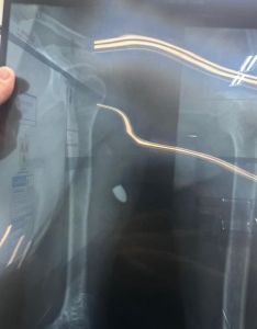 Bala alojada no ombro da vítima de 55 anos