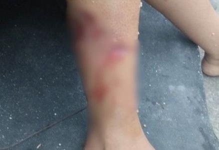 Mulher atacada pitbull Fabriciano