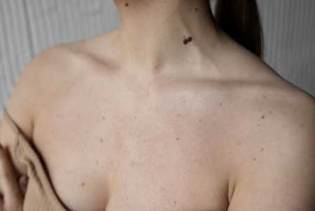 Mulher com verrugas no pescoço
