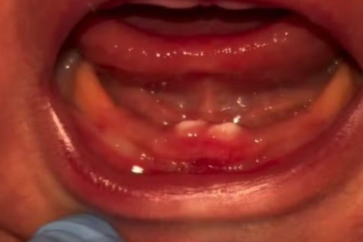 Bebê nasce com dentes e passa por cirurgia nos primeiros dias de vida em Rondônia