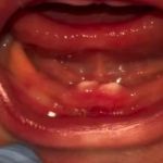 Bebê nasce com dentes e passa por cirurgia nos primeiros dias de vida em Rondônia