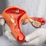 Planos de saúde passam a cobrir DIU hormonal para pacientes com endometriose