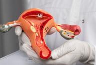 Planos de saúde passam a cobrir DIU hormonal para pacientes com endometriose