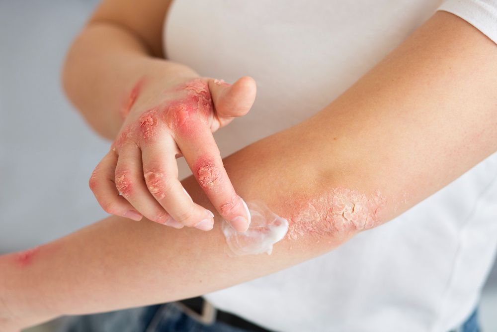 Síndrome rara ligada a pomadas com corticoide intriga médicos